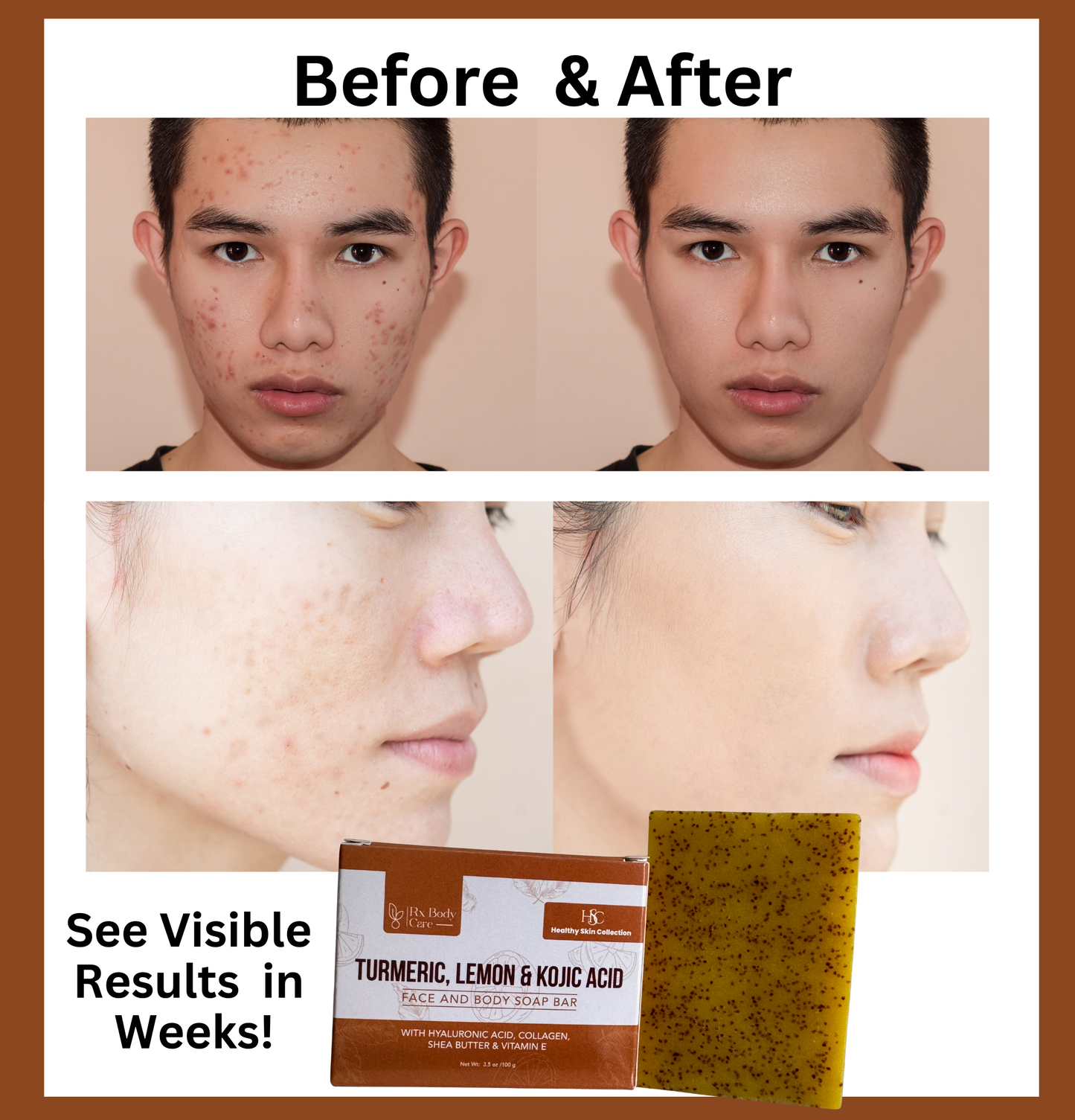 Dark Spot and Hyperpigmentation Turmeric, Lemon and Kojic Acid Soap Bar
